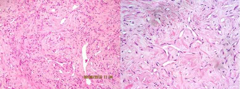 Fig 1, 2: diffuse proliferation of polygonal and spindled tumor cells with round or ovoid nuclei 