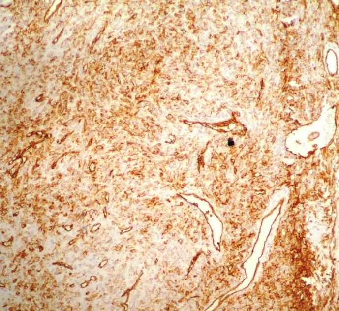 Fig 3: IHC study revealed positivity tumor cells with CD 34 marker. &times;200