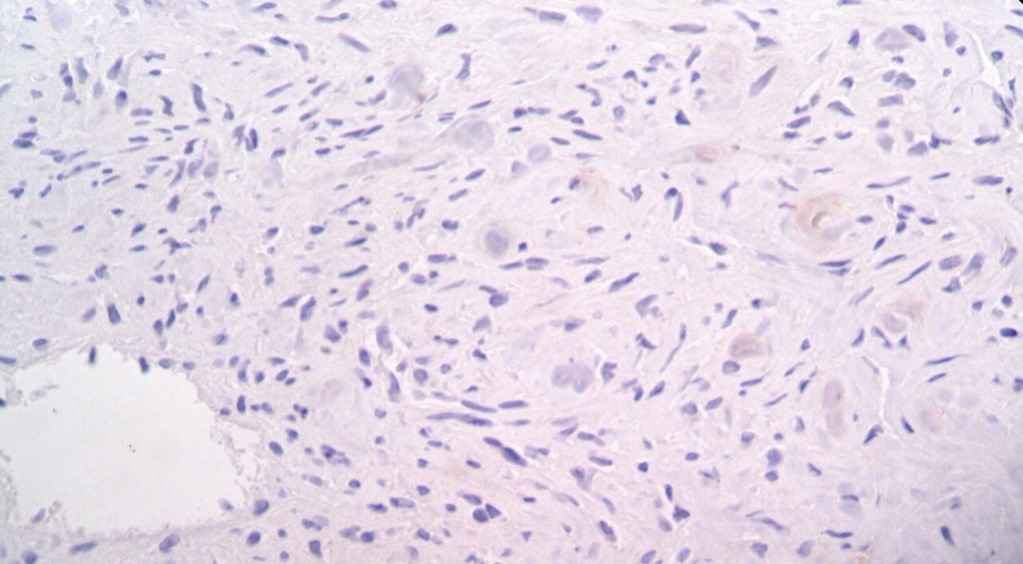 Fig 4: IHC study revealed negative tumor cells with EMA marker. &times;200