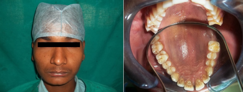 Fig. 1: Extraoral photograph showing no facial asymmetry (a); intraoral photograph showing no significant swelling or vestibular changes (b)
