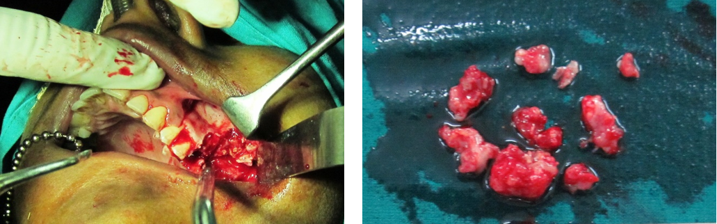  Fig. 3: Photograph showing surgical intervention and the gross specimen after surgery (a & b)