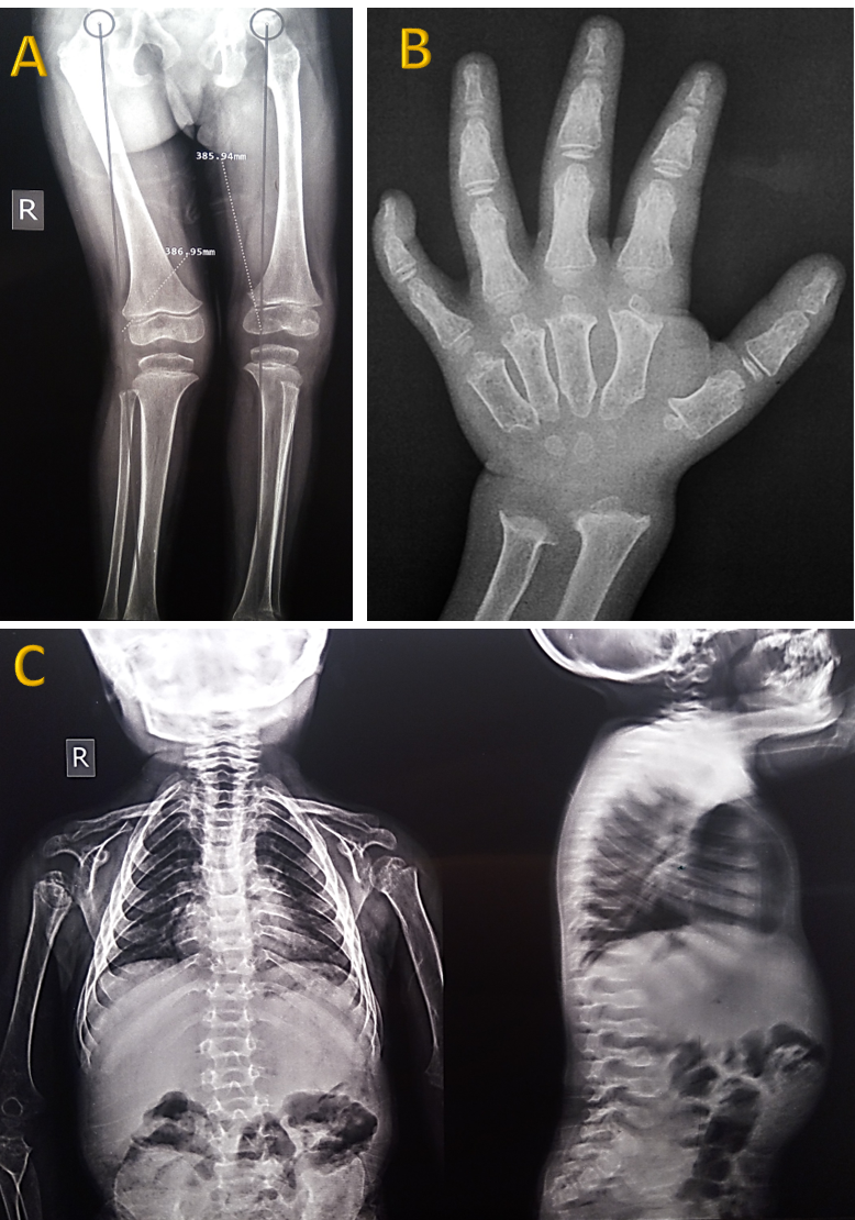 Fig. 1. Skeletal abnormalities in our case of mucopolysaccharidosis type IVA. X- ray examination shows genu valgus (A), metaphyseal dysplasia, proximal metacarpal beaking, ulnar deviation of radius and ulna (B) and kyphoscoliosis (C).